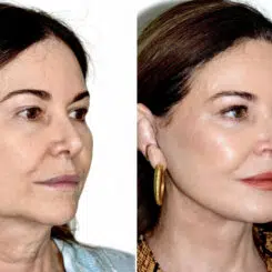 Deep Plane Facelift Before and After Photos in Miami, FL, Patient 30123