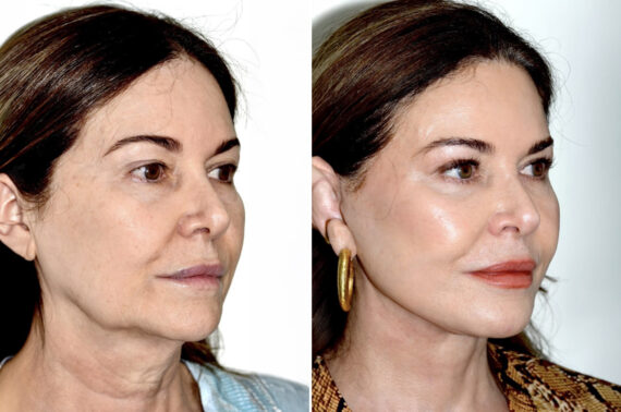 Deep Plane Facelift Before and After Photos in Miami, FL, Patient 30123