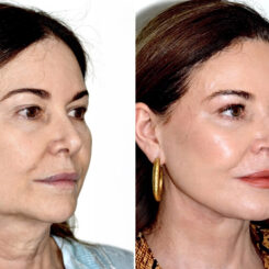 Deep Plane Facelift Before and After Photos in Miami, FL, Patient 30123