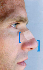 Reasons To Undergo Secondary Rhinoplasty