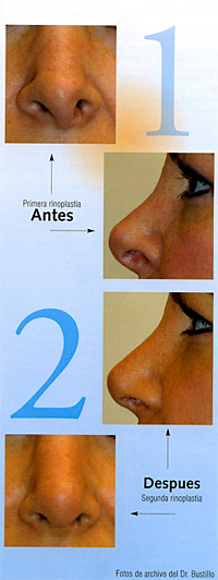 Secondary Rhinoplasty Preparation by Dr. Bustillo