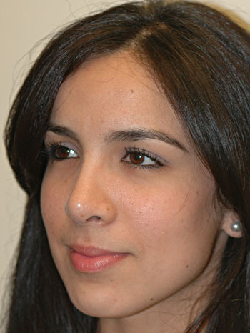 Post-Operative Oblique View of Revision Rhinoplasty