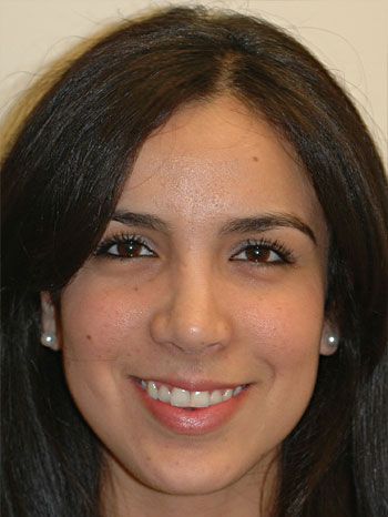 Post-Operative Front View of Revision Rhinoplasty