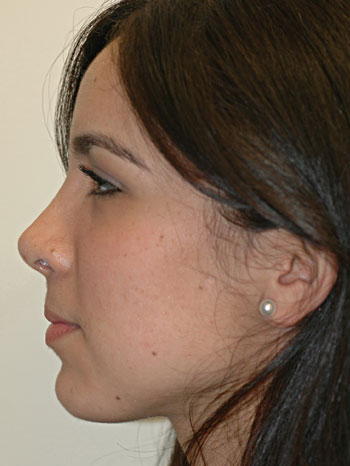 Post Op Oblique View of Revision Rhinoplasty