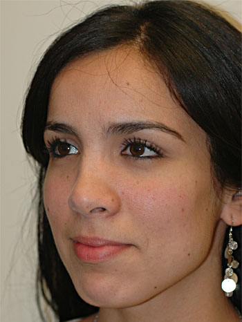 Pre-Operative Oblique View of Revision Rhinoplasty