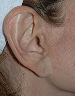 Facelift | Miami, FL